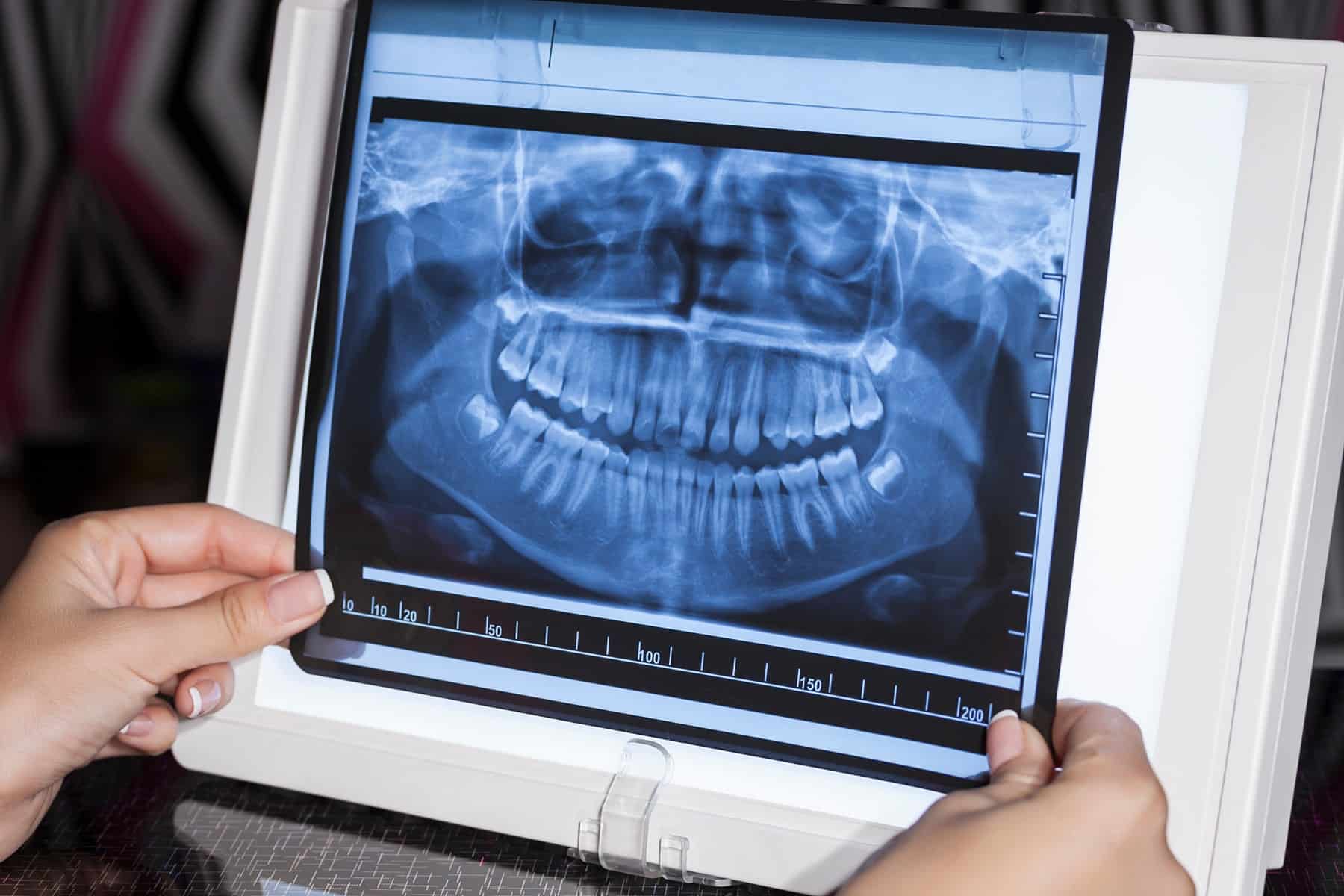 Dental X-rays in Cumming, GA