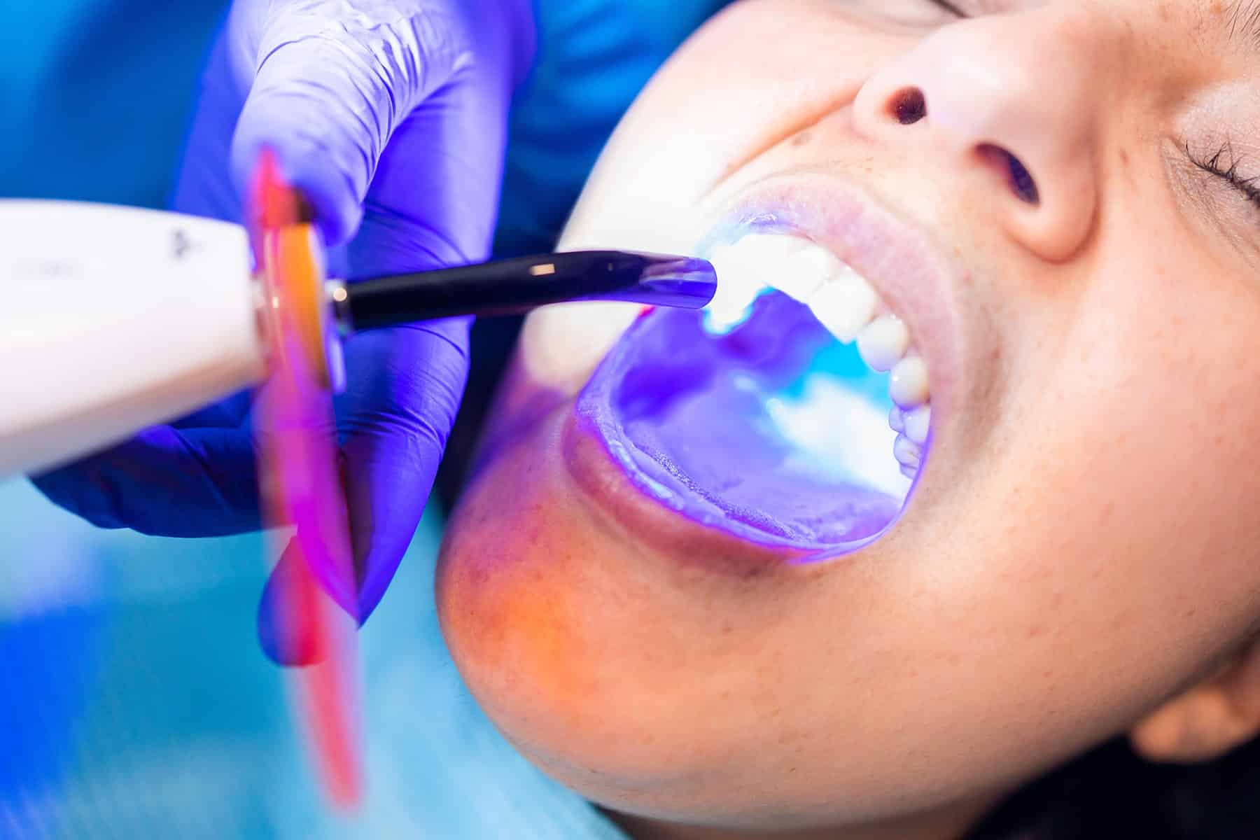Dental bonding treatment in Cumming, GA