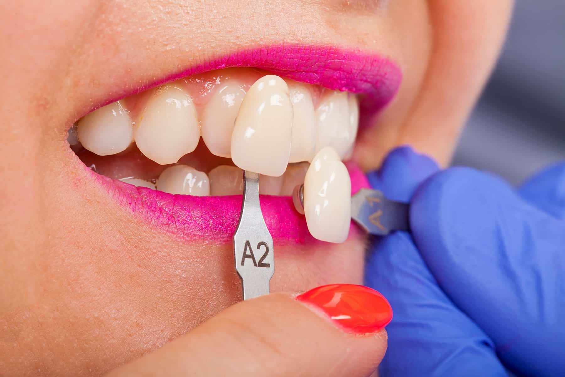 Tooth veneers dentist in Cumming, GA