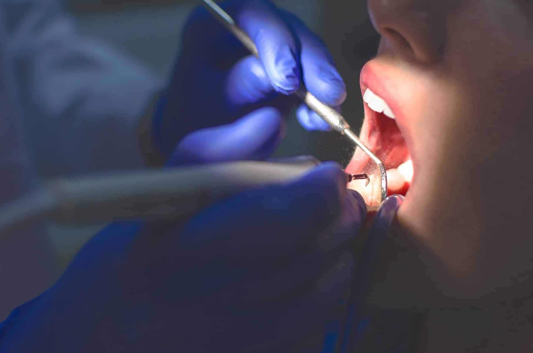 Dental scaling in Cumming, GA