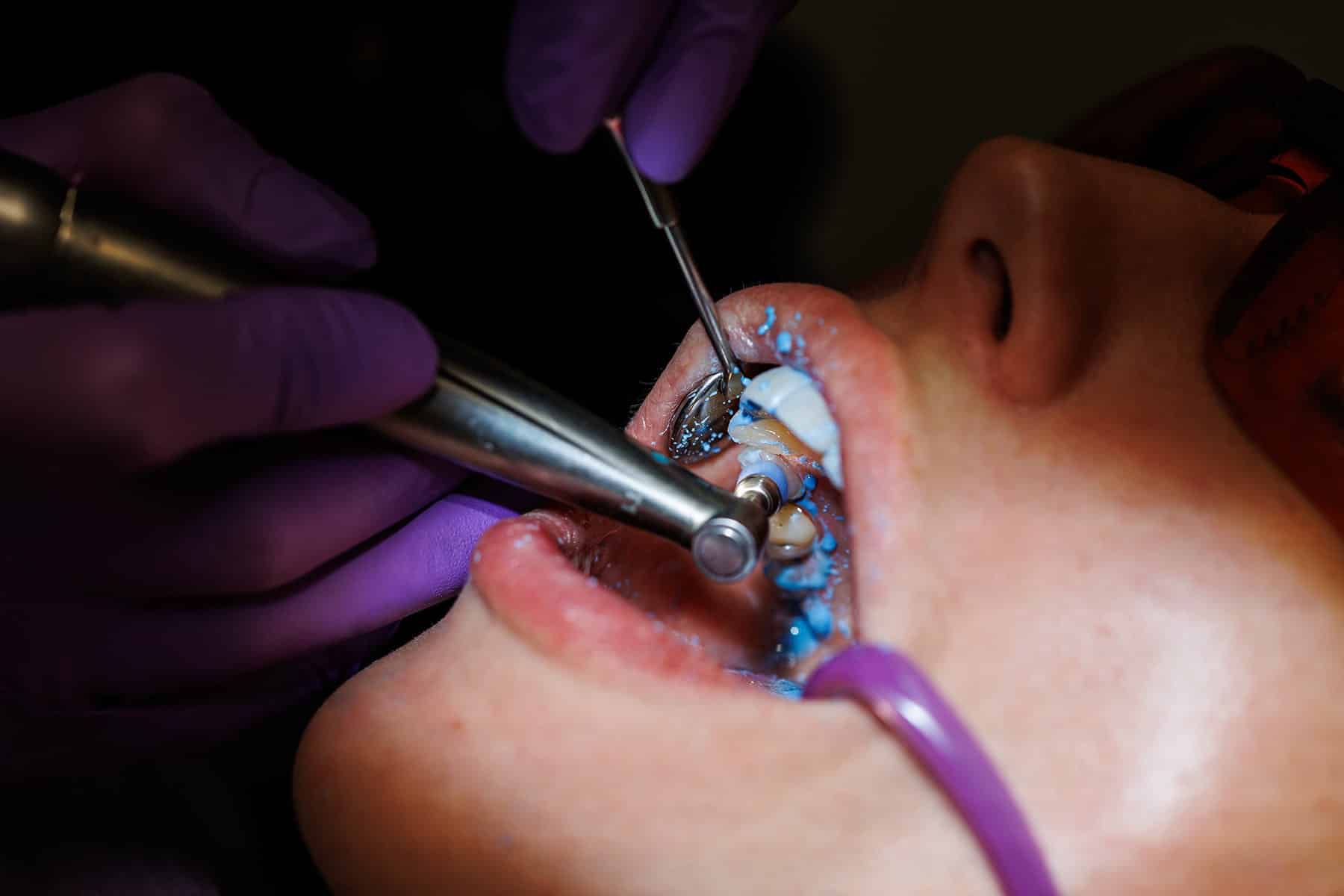 Dental fluoride in Cumming, GA